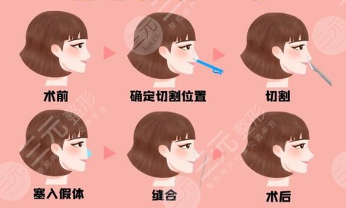 假体隆鼻