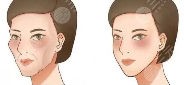 自体脂肪填充面部