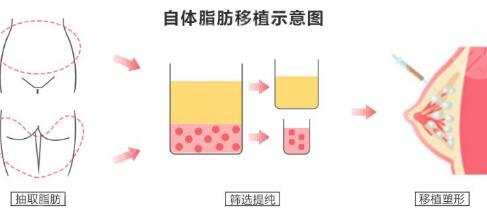 自体脂肪丰胸