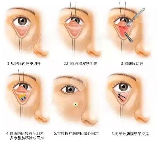 定点双眼皮