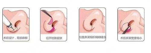 北京联合丽格做鼻子