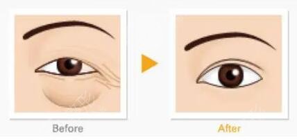 中山大学中山眼科中心割眼袋案例