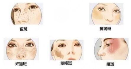 广州医科大学附属第一医院祛斑案例