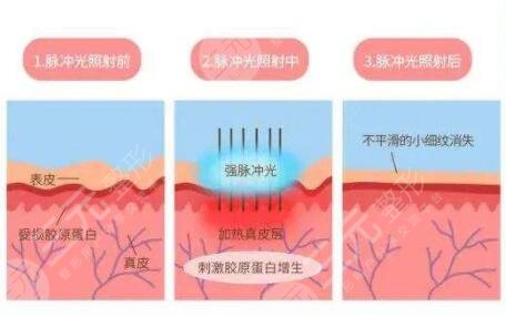 成都市第二人民医院光子嫩肤案例