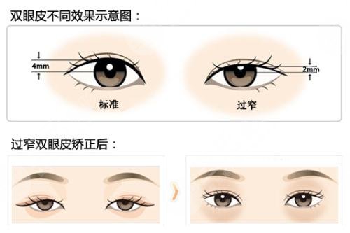 广东省第二人民医院双眼皮术后案例反馈：术后