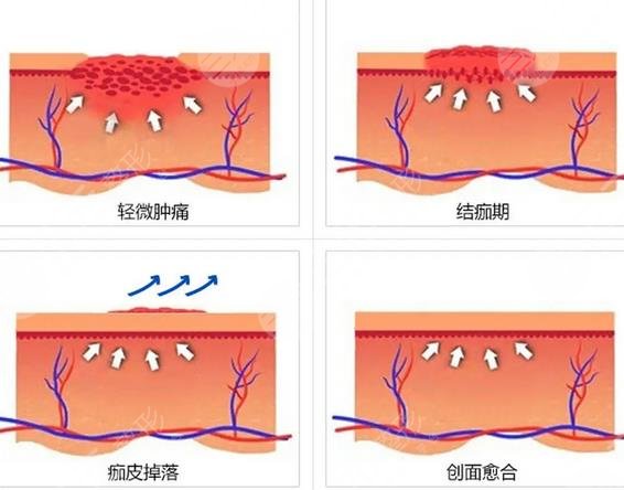 中山三院激光点痣知识科普
