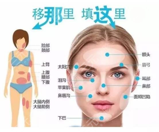 南方医科大学南方医院脂肪填充面部真实案例:术前