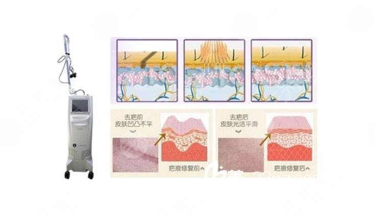 广州中山三院点阵激光祛疤案例分享：术中