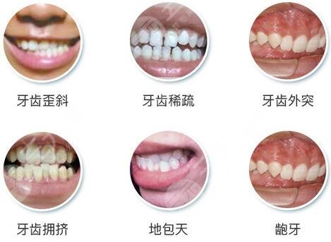 广州华侨医院牙齿矫正知识科普