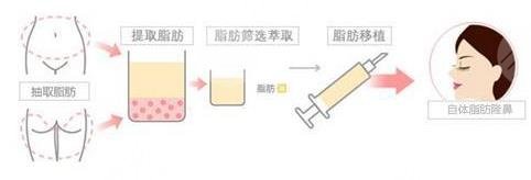 自体脂肪隆鼻