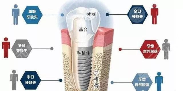 深圳第二人民医院口腔科种植牙案例