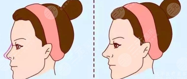 自体脂肪隆鼻