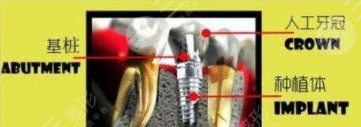 南京市口腔医院种植牙案例