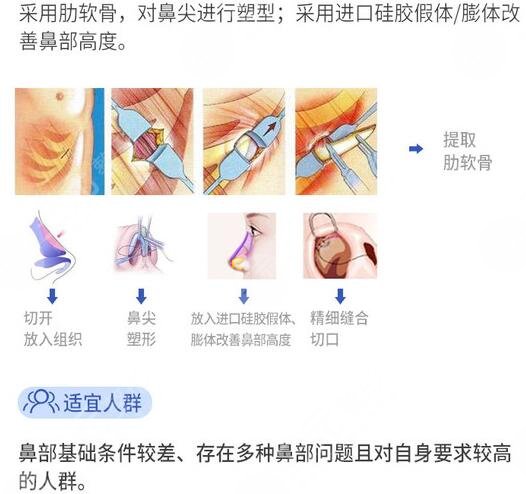 牛克辉科普肋骨隆鼻知识