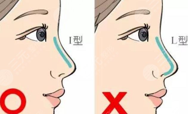 隆鼻