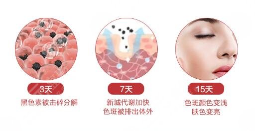 南宁华美激光去黄褐斑项目案例体验反馈：