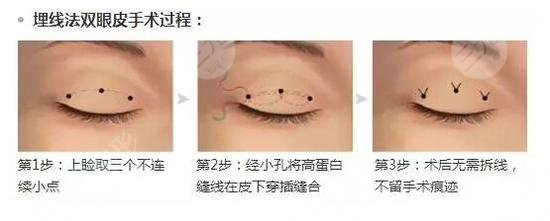 广东省人民医院双眼皮案例展示