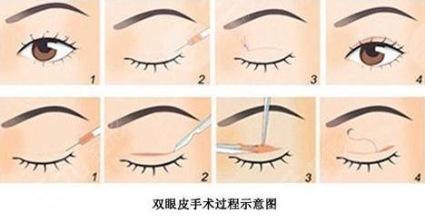 广东省人民医院双眼皮案例展示
