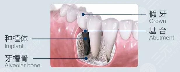 惠州做种植牙项目科普