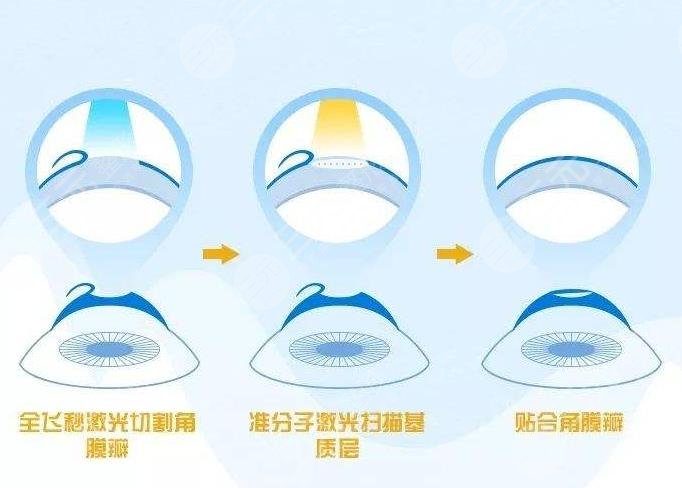 近视眼手术技术