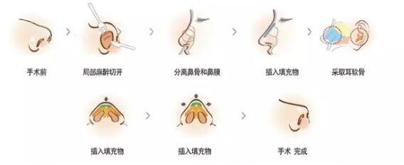隆鼻过程