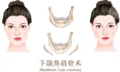 下颌角整形手术