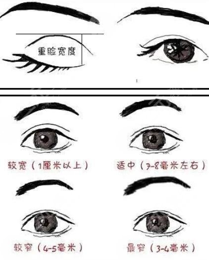 上海九院双眼皮修复案例