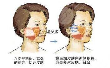 北京八大处拉皮案例参考