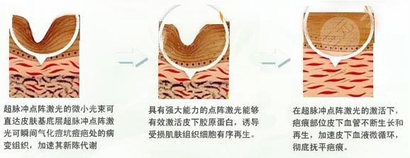 北京协和医院激光祛痘坑案例果