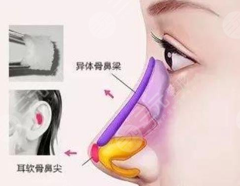 鼻部手术