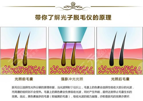 肇庆市第一人民医院激光脱毛案例