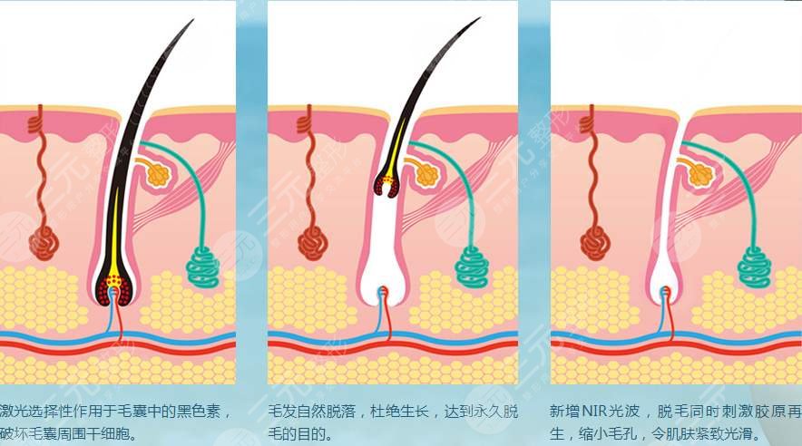 肇庆市第一人民医院激光脱毛案例