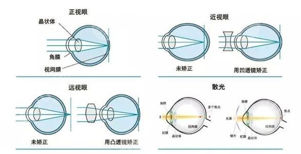 北京大学第一医院激光近视矫正案例术后反馈