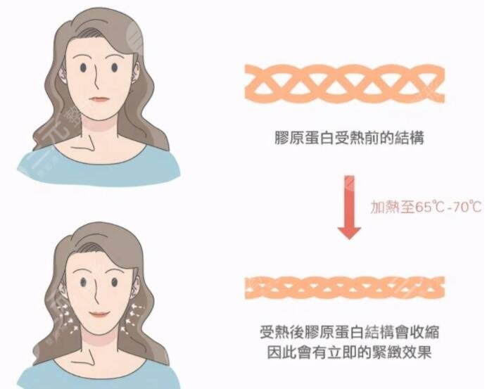 上海九院做拉皮手术果