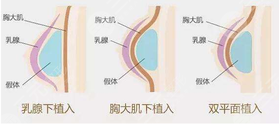傲诺拉星熠隆胸价格影响因素