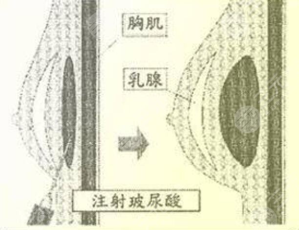 自体脂肪隆胸怎么做?