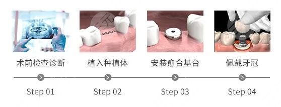 无锡牙齿种植案例分享