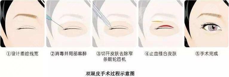 广州南方医院双眼皮价格收费高吗
