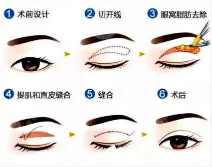 广州南方医院整形外科双眼皮果图