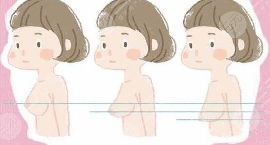 北京八大处乳房下垂矫正科普