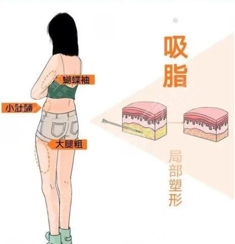 北京协和医院整形科吸脂抽脂项目案例体验反馈：