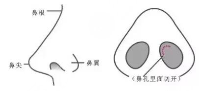 鼻整形