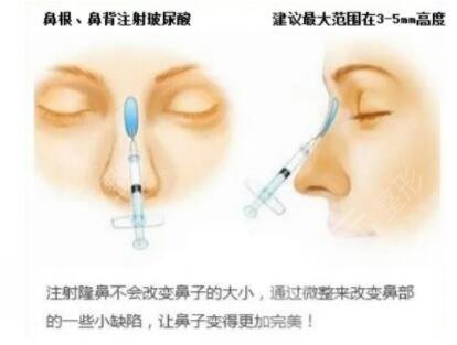 上海华美鼻部整形科普