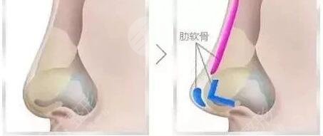 北京八大处膨体隆鼻项目案例体验反馈：