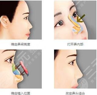 鼻子假体取出