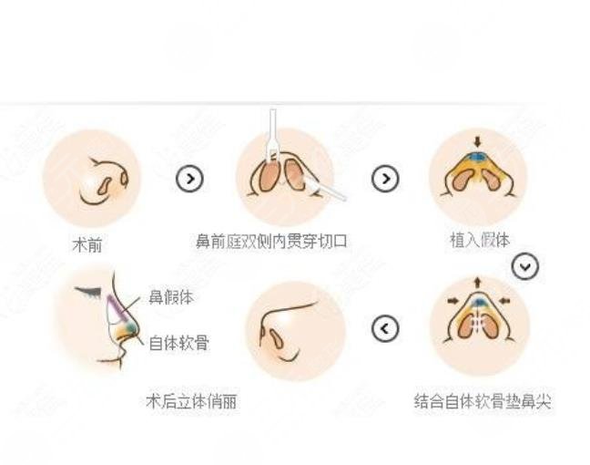 鼻部手术整形如何避免留下疤痕?
