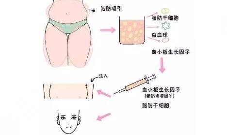 杭州艺星做脂肪填充怎么样?