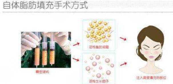 杭州艺星面部脂肪填充项目案例体验反馈：