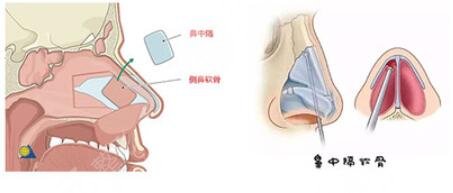 北医三院整形科鼻部整形手术项目案例体验反馈：