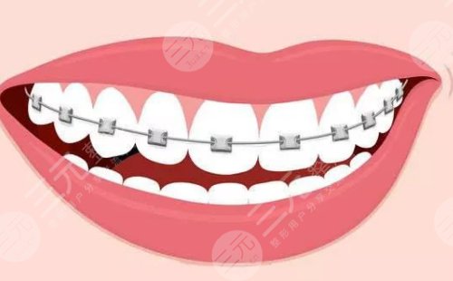 牙齿矫正手术